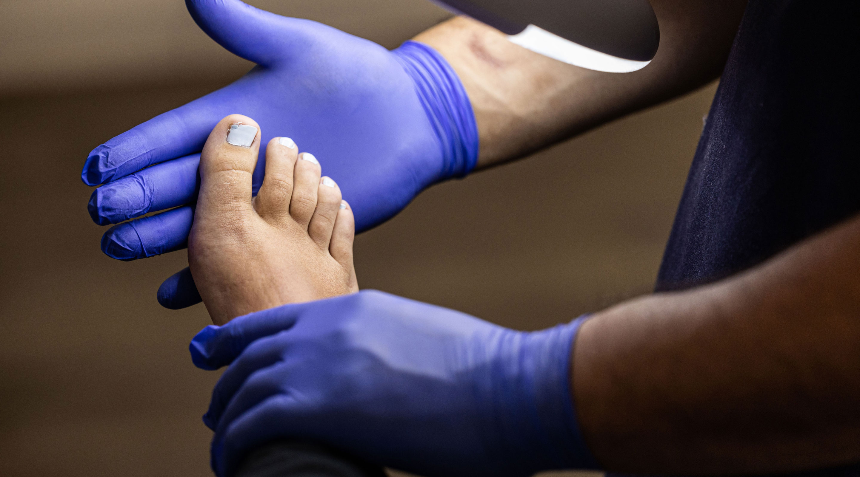 Ingrown Toenails Hero